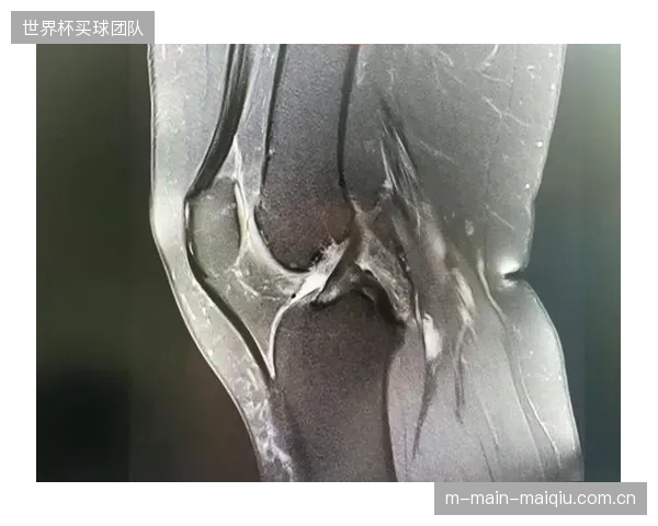 AnalogDevices分析了超过百万组跌落数据，其算法对引发膝关节前十字韧带（ACL）损伤的特定旋转模式的预测准确率达到92%